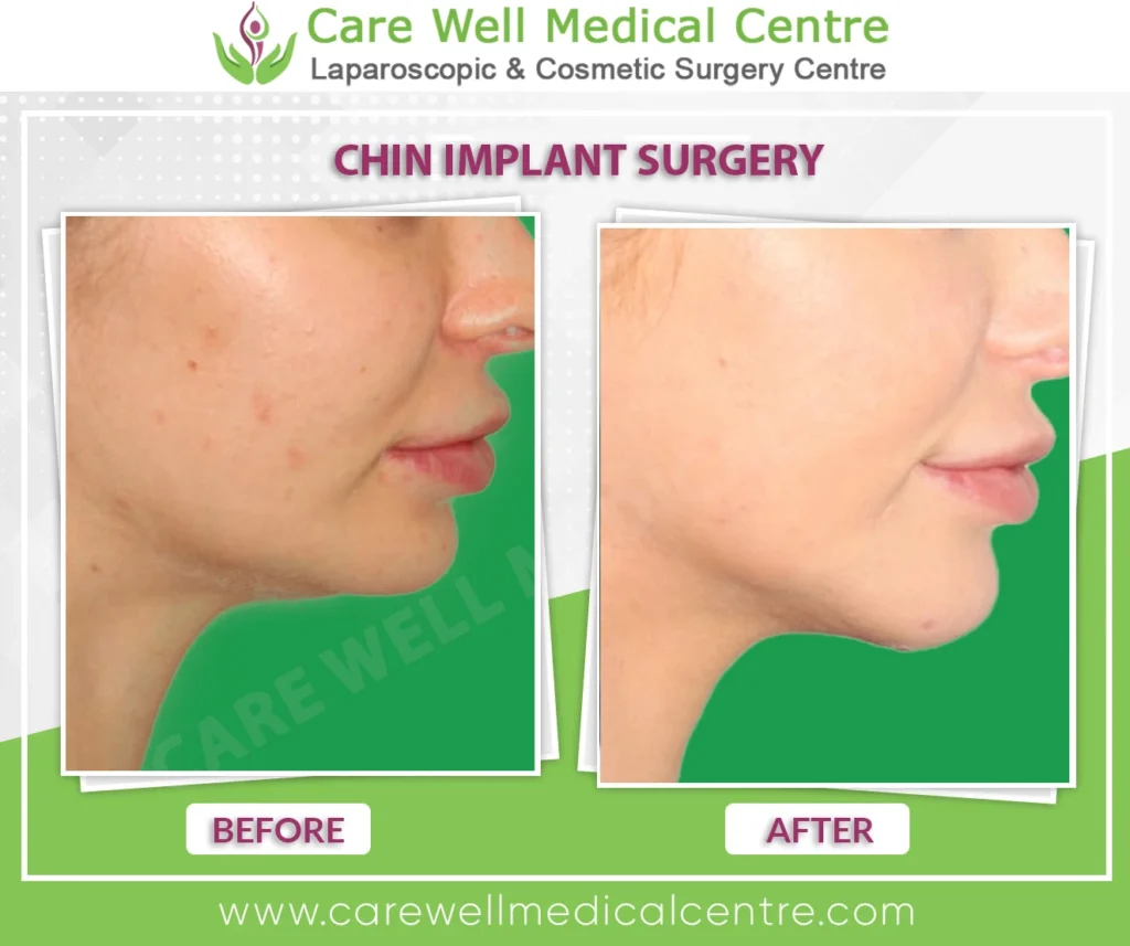 Chin augmentation before and after – Indian female
