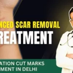 Hesitation cut marks treatment and scar removal in Delhi – Dr. Sandeep Bhasin