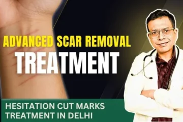 Hesitation cut marks treatment and scar removal in Delhi – Dr. Sandeep Bhasin