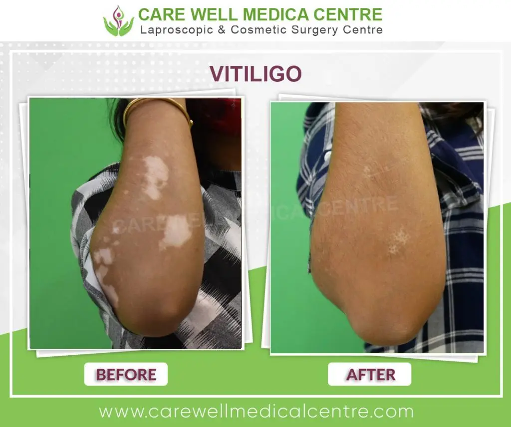 Cheek Vitiligo patient transformation results Delhi Care Well