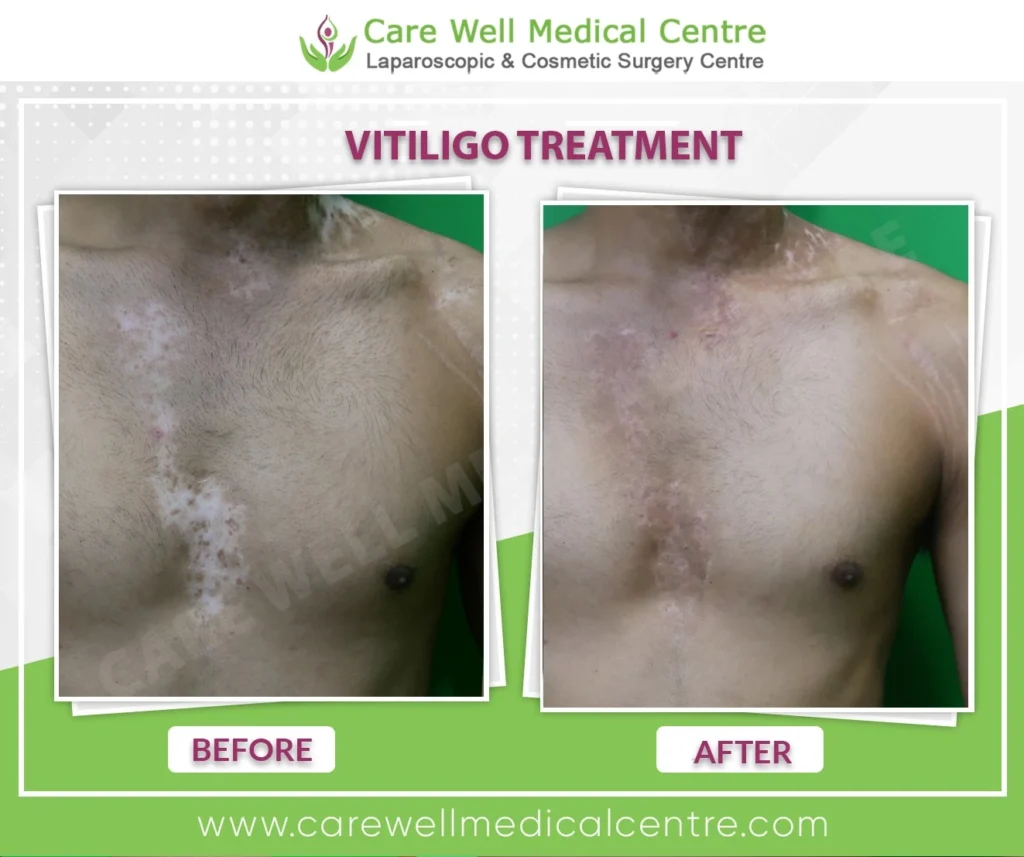 Chest vitiligo recovery results by Dr Sandeep Bhasin Delhi