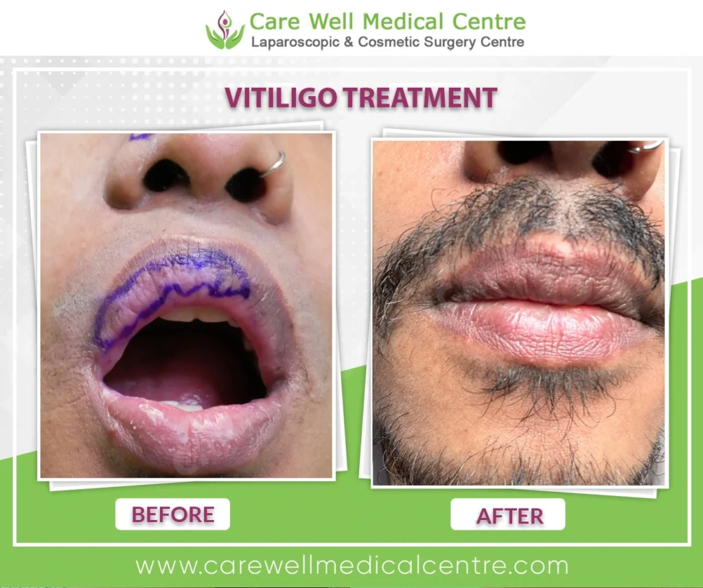 Permanent lips vitiligo transplant results in Delhi clinic