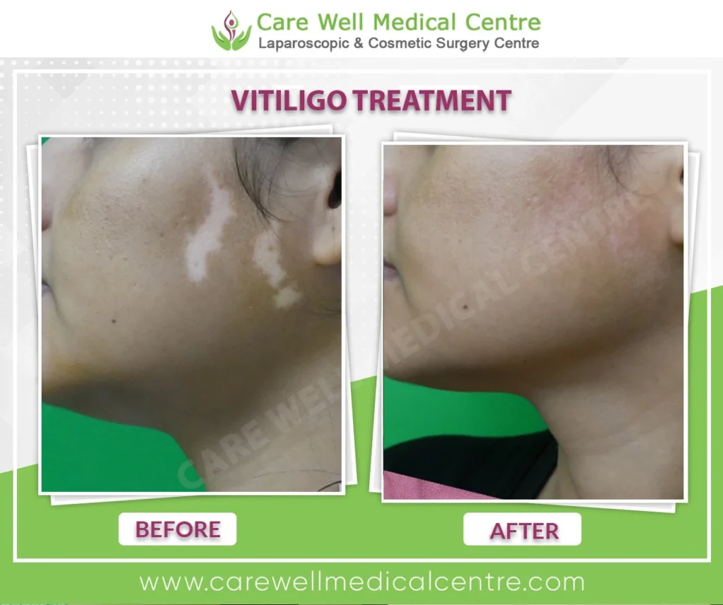face vitiligo surgery results at Care Well Medical Centre