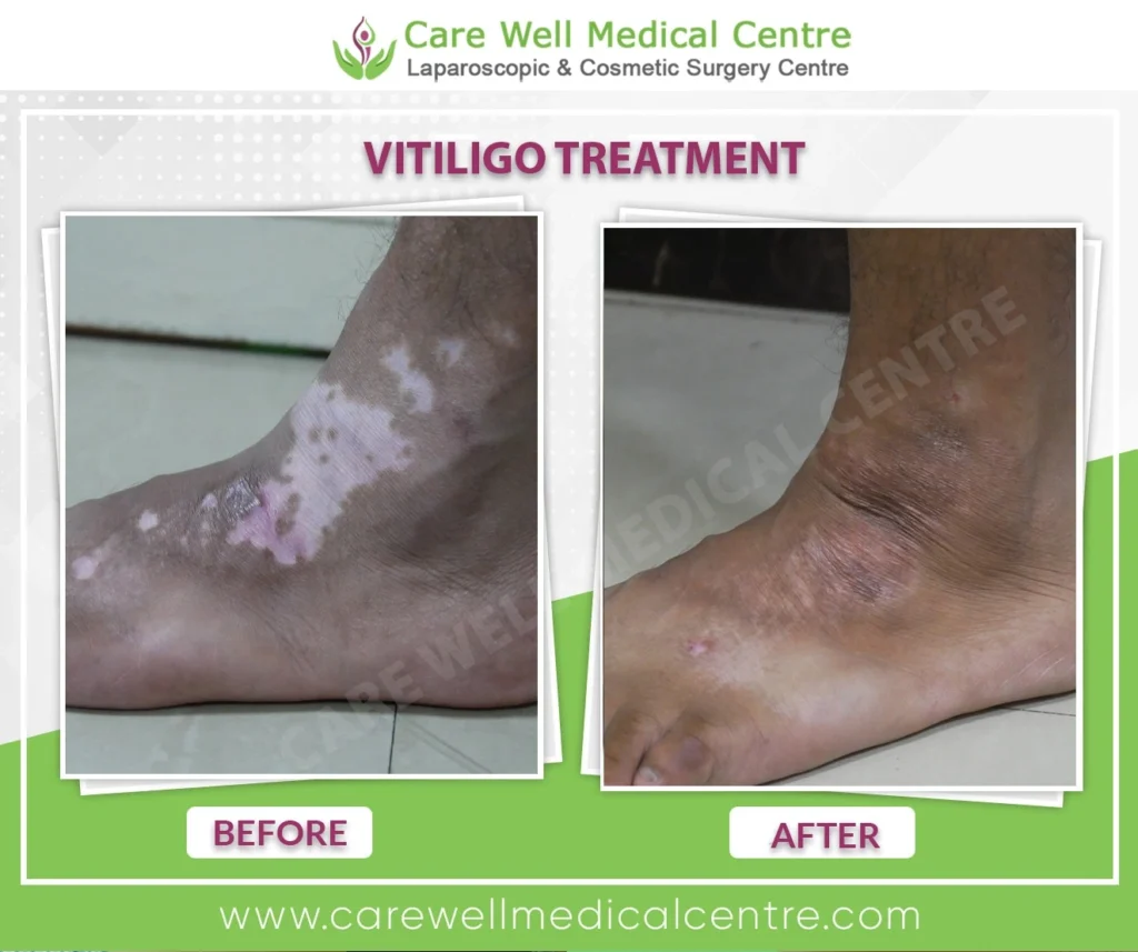 Best legs vitiligo before and after photos Delhi