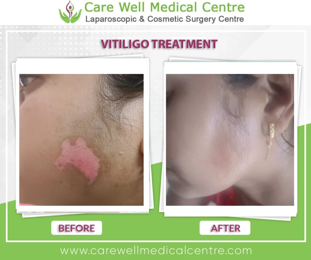 Vitiligo treatment before after results in Delhi