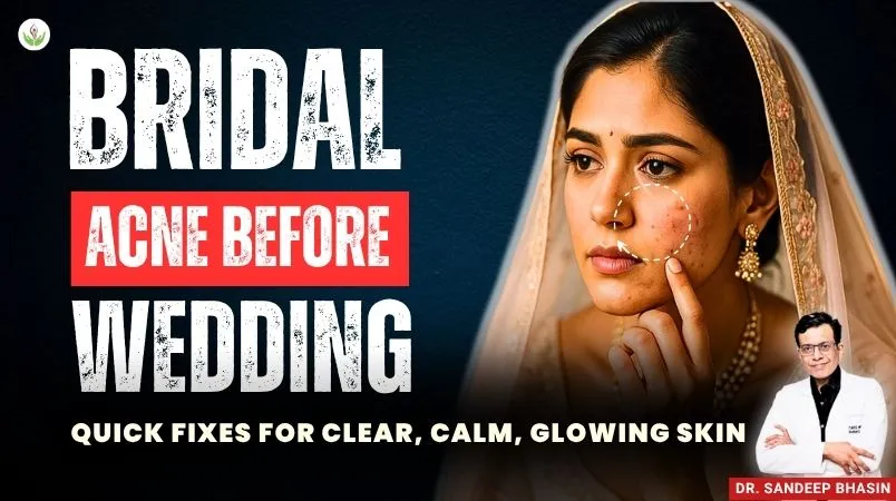 Bridal acne before wedding treatment by Dr. Sandeep Bhasin at Care Well Medical Centre Delhi
