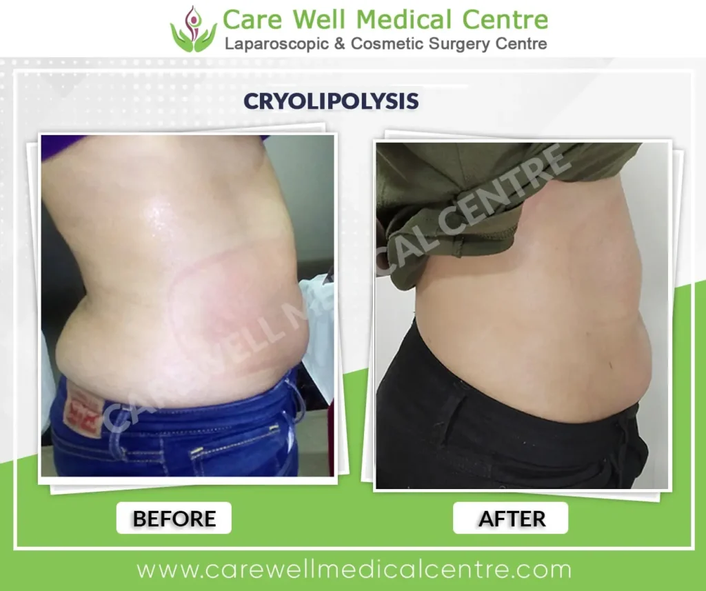 Cryolipolysis side belly fat reduction before and after Delhi