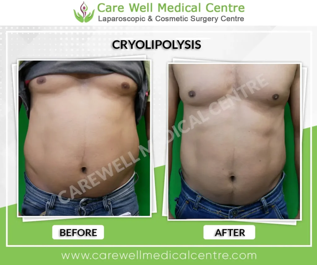 Cryolipolysis male abdomen before and after in Delhi