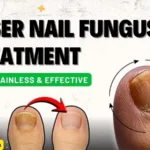 Laser Nail Fungus Treatment in Delhi