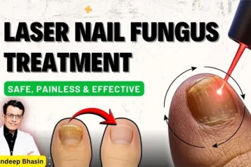 Laser Nail Fungus Treatment in Delhi