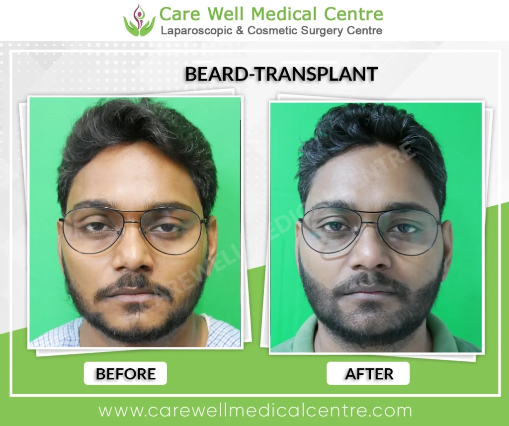 Beard transplant before and after front view result