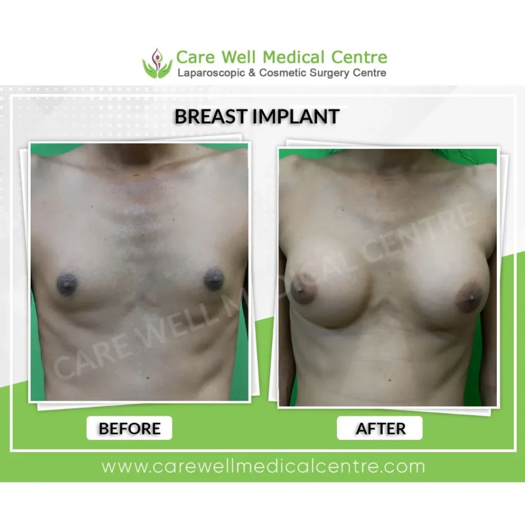 Male to female breast augmentation before and after results using silicone implants