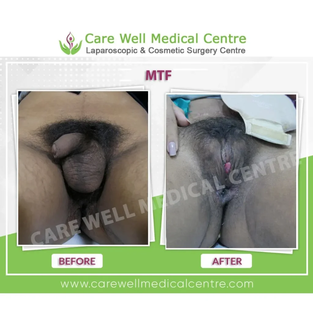 Sex reassignment surgery before and after comparison for male to female transition