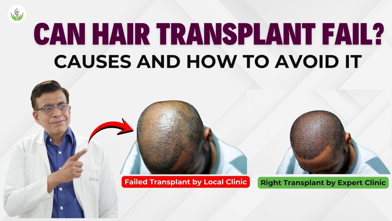 Can Hair Transplant Fail