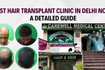 Best Hair Transplant Clinic in Delhi NCR