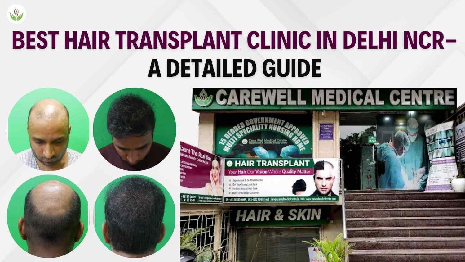Best Hair Transplant Clinic in Delhi NCR