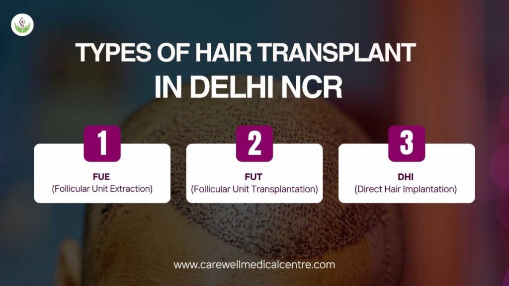 Types of Hair Transplant in Delhi NCR