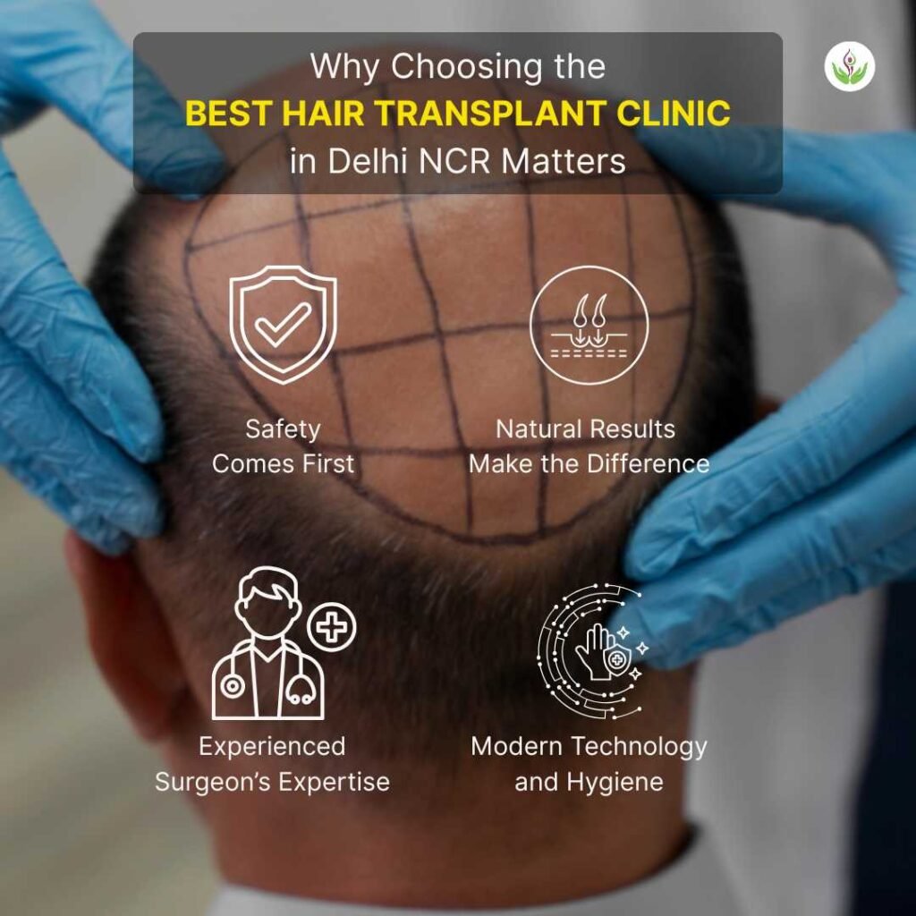 Why Choosing the Best Hair Transplant Clinic in Delhi NCR Matters