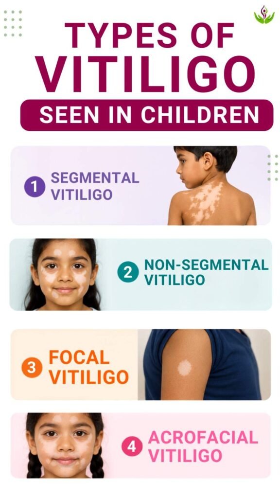 Types of Vitiligo Seen in Children